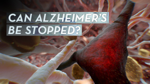 alzheimers